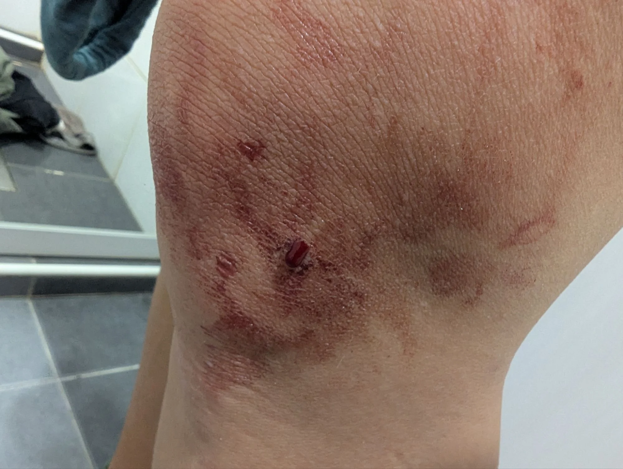 And at home we treated Racki&rsquo;s and Tom&rsquo;s wounds from leeches. For some reason the leeches did not suck on me. Maybe the mosquitos already had taken all my blood 😳